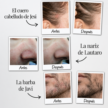 Serum ANTI dermatitis Sarborreica